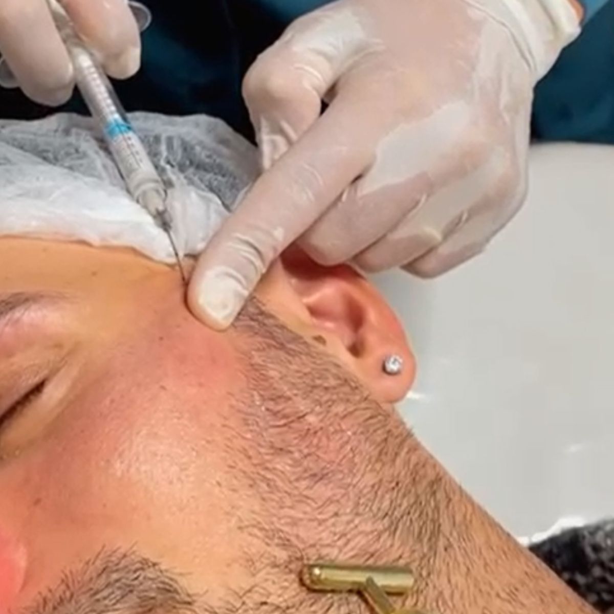 Preenchimento Facial