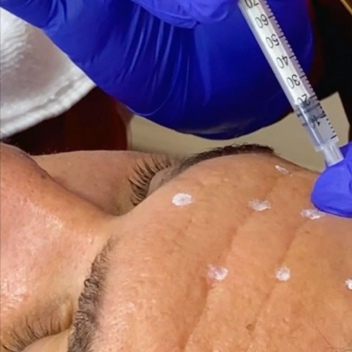 Aplicação de Toxina